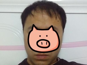 头上有小绒毛发开始长长、长粗了,应该不是心理因素