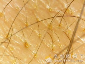 用头发检测仪拍头发的照片,与一个月前的情况作对比