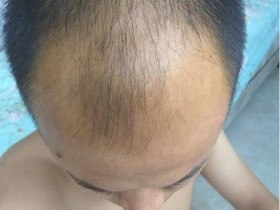 对着太阳照镜子,不用头皮检测仪也能看到头皮的小绒毛