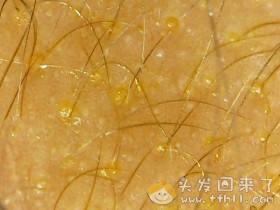 头皮检测仪记录小Y头发生长的图片（2018年8月17日）