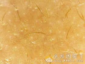 头皮检测仪记录小Y头发生长的图片（2018年8月8日）