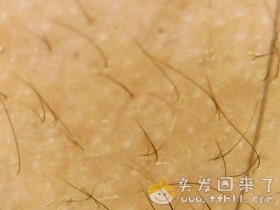 头皮检测仪记录小Y头发生长的图片（2018年12月23日）