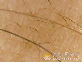 头皮检测仪记录小Y头发生长的图片(2019年3月27日)