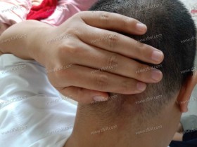 花了230,困扰我两个月的皮脂腺囊肿终于做手术割了