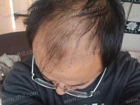 第一瓶米诺地尔酊使用完毕,一滴都没有了!