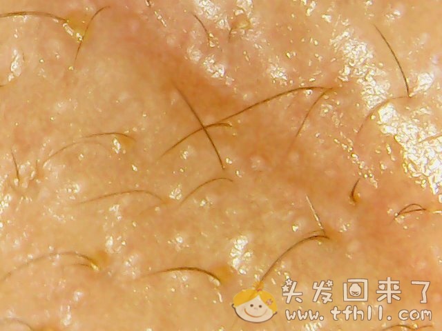 今天又用头皮检测仪拍照了一波头皮的图片，随便对比了一下胡须图片 No.3