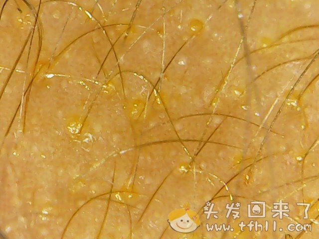 头皮检测仪记录小Y头发生长的图片（2018年8月17日）图片 No.1