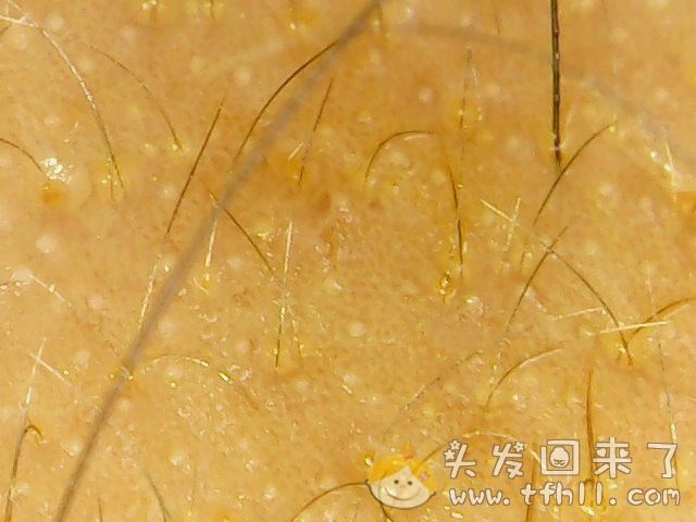 头皮检测仪记录小Y头发生长的图片（2018年8月17日）图片 No.2