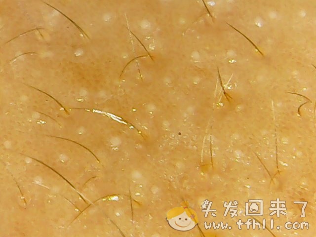 头皮检测仪记录小Y头发生长的图片（2018年8月17日）图片 No.3