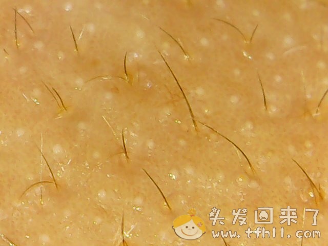 头皮检测仪记录小Y头发生长的图片（2018年8月17日）图片 No.4