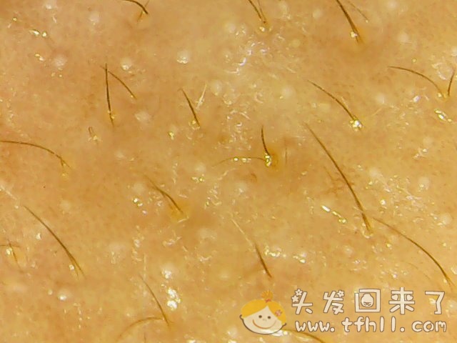 头皮检测仪记录小Y头发生长的图片（2018年8月17日）图片 No.5