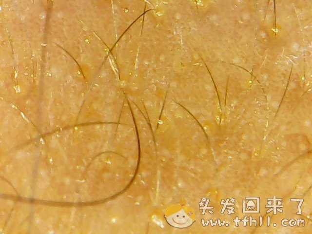 头皮检测仪记录小Y头发生长的图片（2018年8月17日）图片 No.6