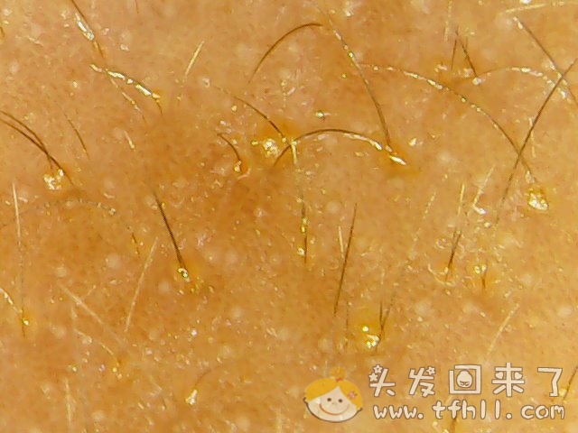 头皮检测仪记录小Y头发生长的图片（2018年8月17日）图片 No.7