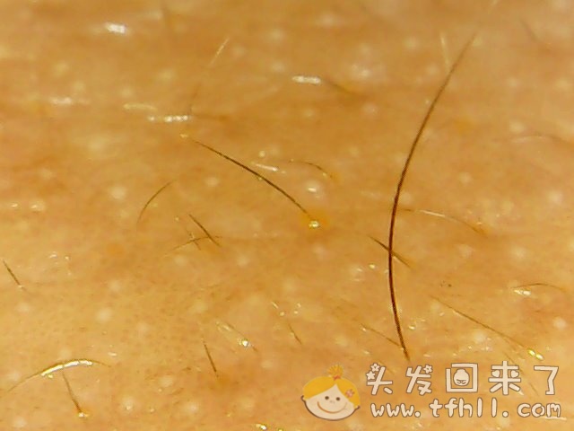 头皮检测仪记录小Y头发生长的图片（2018年8月17日）图片 No.8