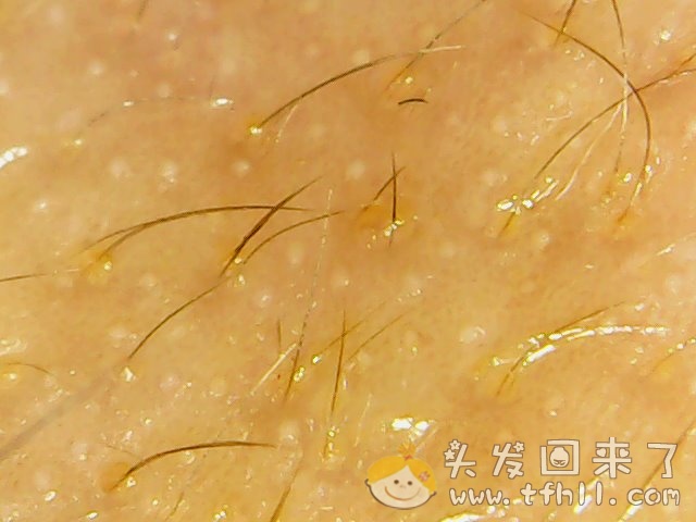 头皮检测仪记录小Y头发生长的图片（2018年8月17日）图片 No.9