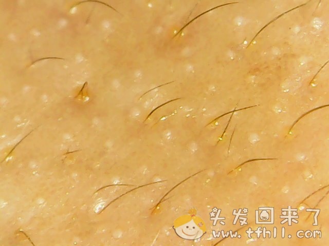 头皮检测仪记录小Y头发生长的图片（2018年8月17日）图片 No.10