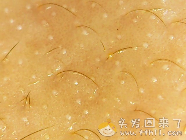 头皮检测仪记录小Y头发生长的图片（2018年8月17日）图片 No.11