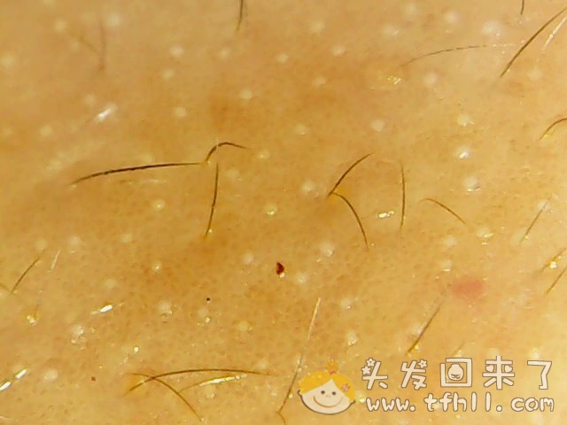 头皮检测仪记录小Y头发生长的图片（2018年8月17日）图片 No.12