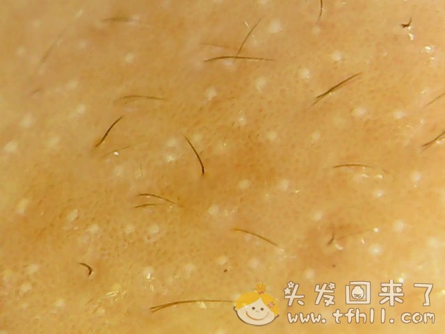头皮检测仪记录小Y头发生长的图片（2018年8月17日）图片 No.13