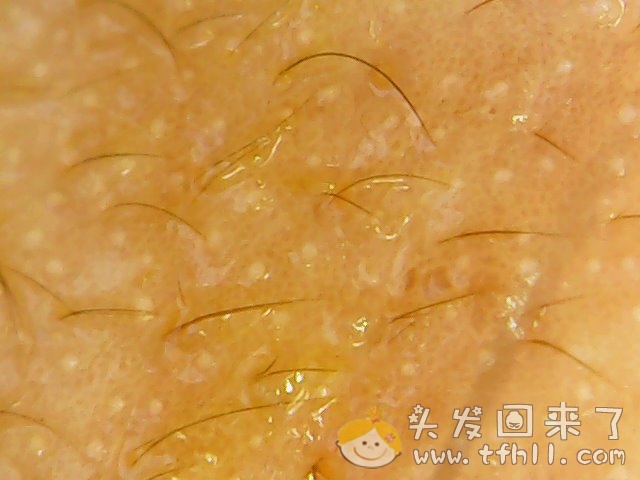 头皮检测仪记录小Y头发生长的图片（2018年8月17日）图片 No.14