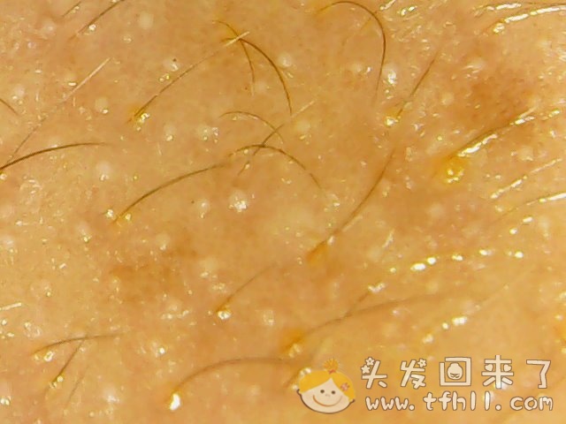 头皮检测仪记录小Y头发生长的图片（2018年8月17日）图片 No.15