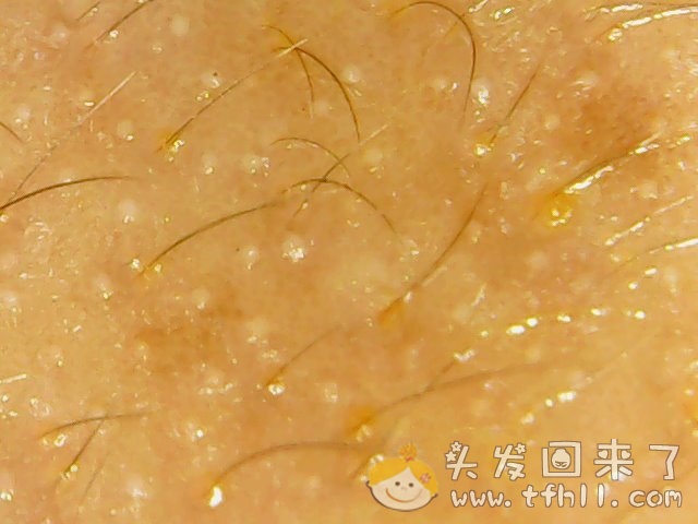 头皮检测仪记录小Y头发生长的图片（2018年8月17日）图片 No.15