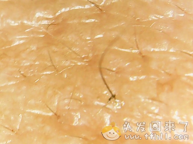 头皮检测仪记录小Y头发生长的图片（2018年8月8日）图片 No.9