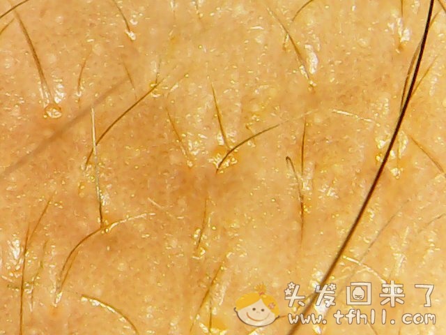 头皮检测仪记录小Y头发生长的图片（2018年8月8日）图片 No.2