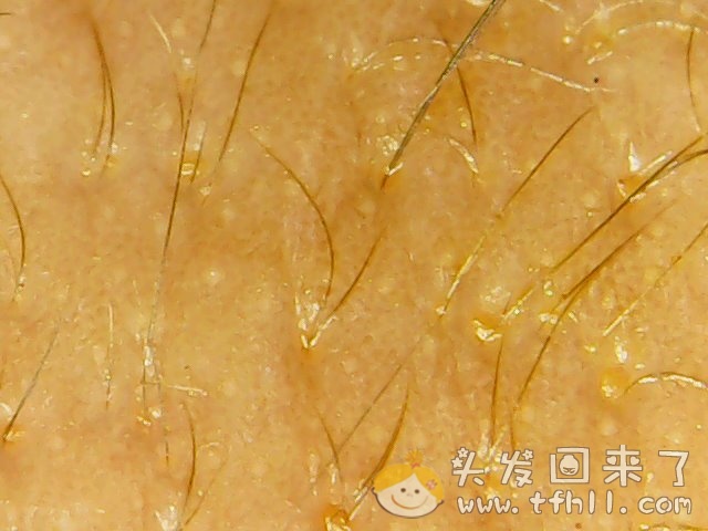 头皮检测仪记录小Y头发生长的图片（2018年8月8日）图片 No.3