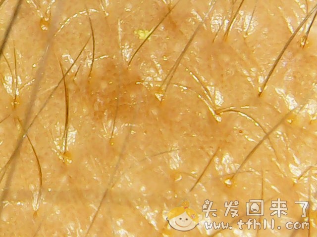 头皮检测仪记录小Y头发生长的图片（2018年8月8日）图片 No.4
