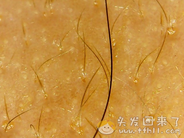 头皮检测仪记录小Y头发生长的图片（2018年8月8日）图片 No.5