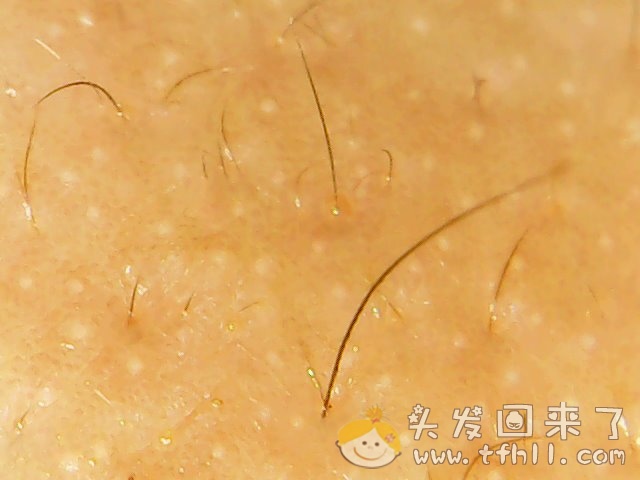 头皮检测仪记录小Y头发生长的图片（2018年8月8日）图片 No.8