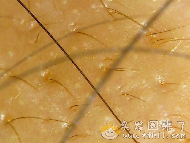 头皮检测仪记录小Y头发生长的图片（2018年8月8日）图片 No.10