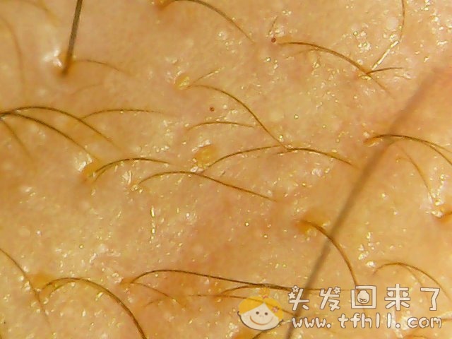 头皮检测仪记录小Y头发生长的图片（2018年8月8日）图片 No.11