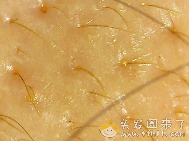 头皮检测仪记录小Y头发生长的图片（2018年8月8日）图片 No.12