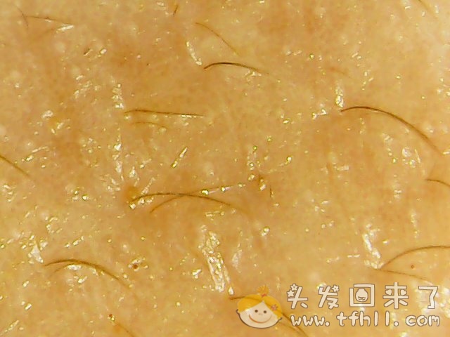 头皮检测仪记录小Y头发生长的图片（2018年8月8日）图片 No.13
