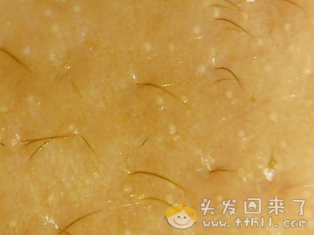 头皮检测仪记录小Y头发生长的图片（2018年8月8日）图片 No.14