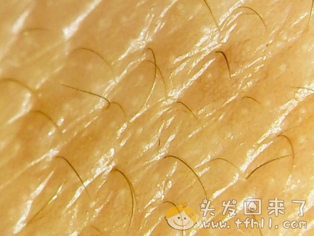 头皮检测仪记录小Y头发生长的图片（2018年8月8日）图片 No.15