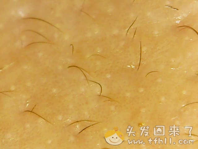 头皮检测仪记录小Y头发生长的图片（2018年8月8日）图片 No.16