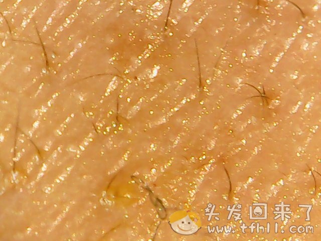 头皮检测仪记录小Y头发生长的图片（2018年10月15日）图片 No.1