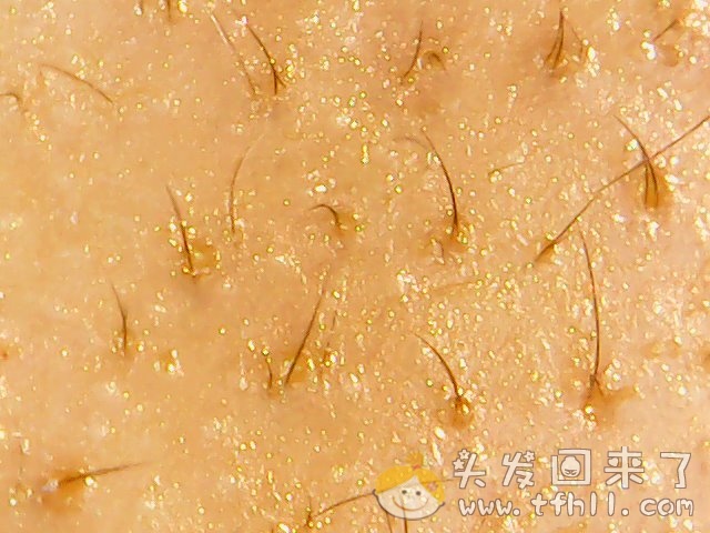 头皮检测仪记录小Y头发生长的图片（2018年10月15日）图片 No.2