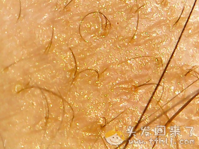 头皮检测仪记录小Y头发生长的图片（2018年10月15日）图片 No.3