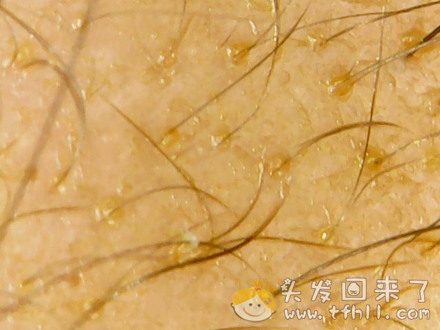 头皮检测仪记录小Y头发生长的图片（2018年10月15日）图片 No.4