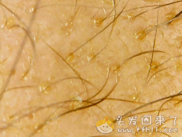 头皮检测仪记录小Y头发生长的图片（2018年10月15日）图片 No.4