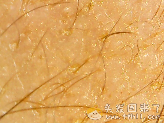 头皮检测仪记录小Y头发生长的图片（2018年10月15日）图片 No.5
