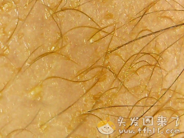 头皮检测仪记录小Y头发生长的图片（2018年10月15日）图片 No.6
