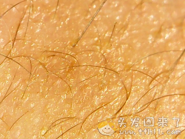 头皮检测仪记录小Y头发生长的图片（2018年10月15日）图片 No.7