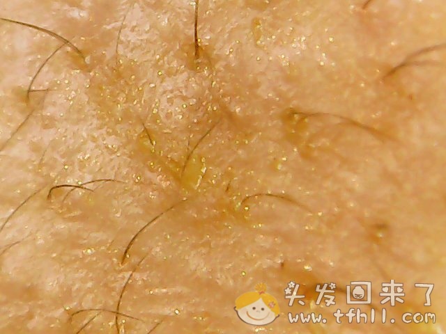 头皮检测仪记录小Y头发生长的图片（2018年10月15日）图片 No.8