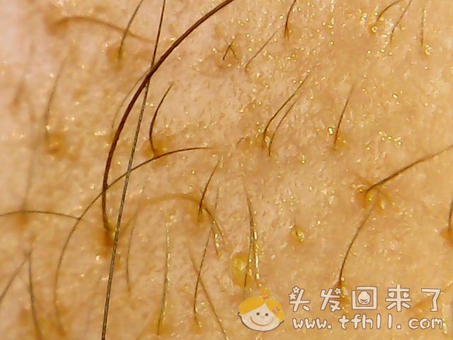 头皮检测仪记录小Y头发生长的图片（2018年10月15日）图片 No.9