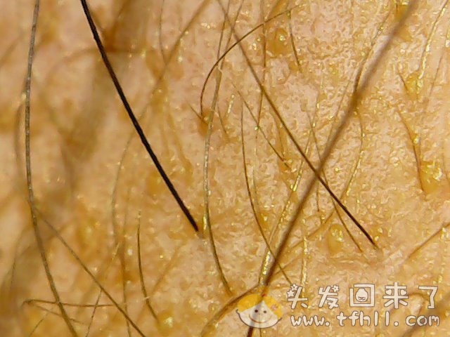 头皮检测仪记录小Y头发生长的图片（2018年10月15日）图片 No.10